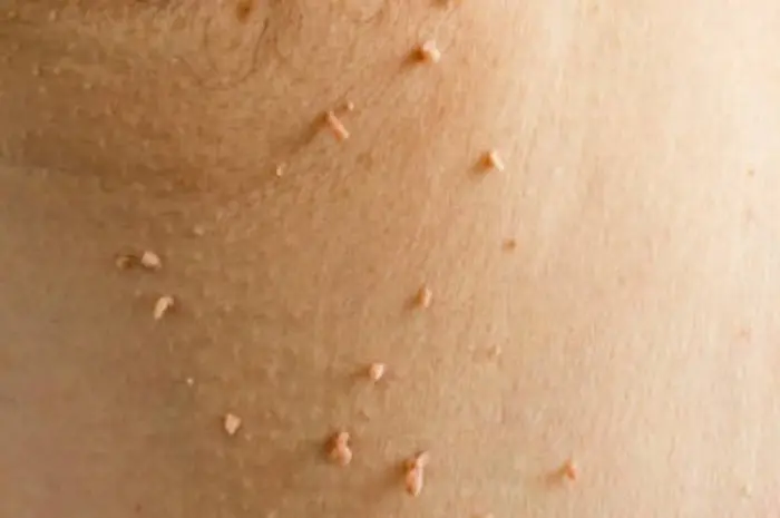 Causes of Skin Tags