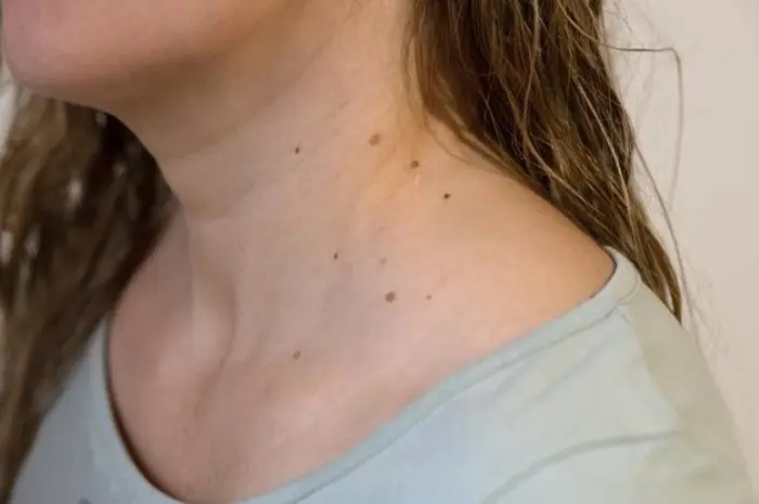 Preventing Skin Tags in the Future