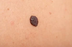 Safe and Easy Skin Tag Removal: A Step-by-Step Guide Based