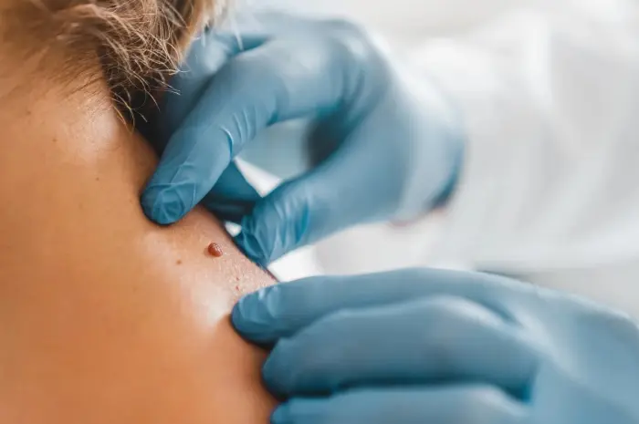 Skin Tag Removal Home Remedies, According To Experts